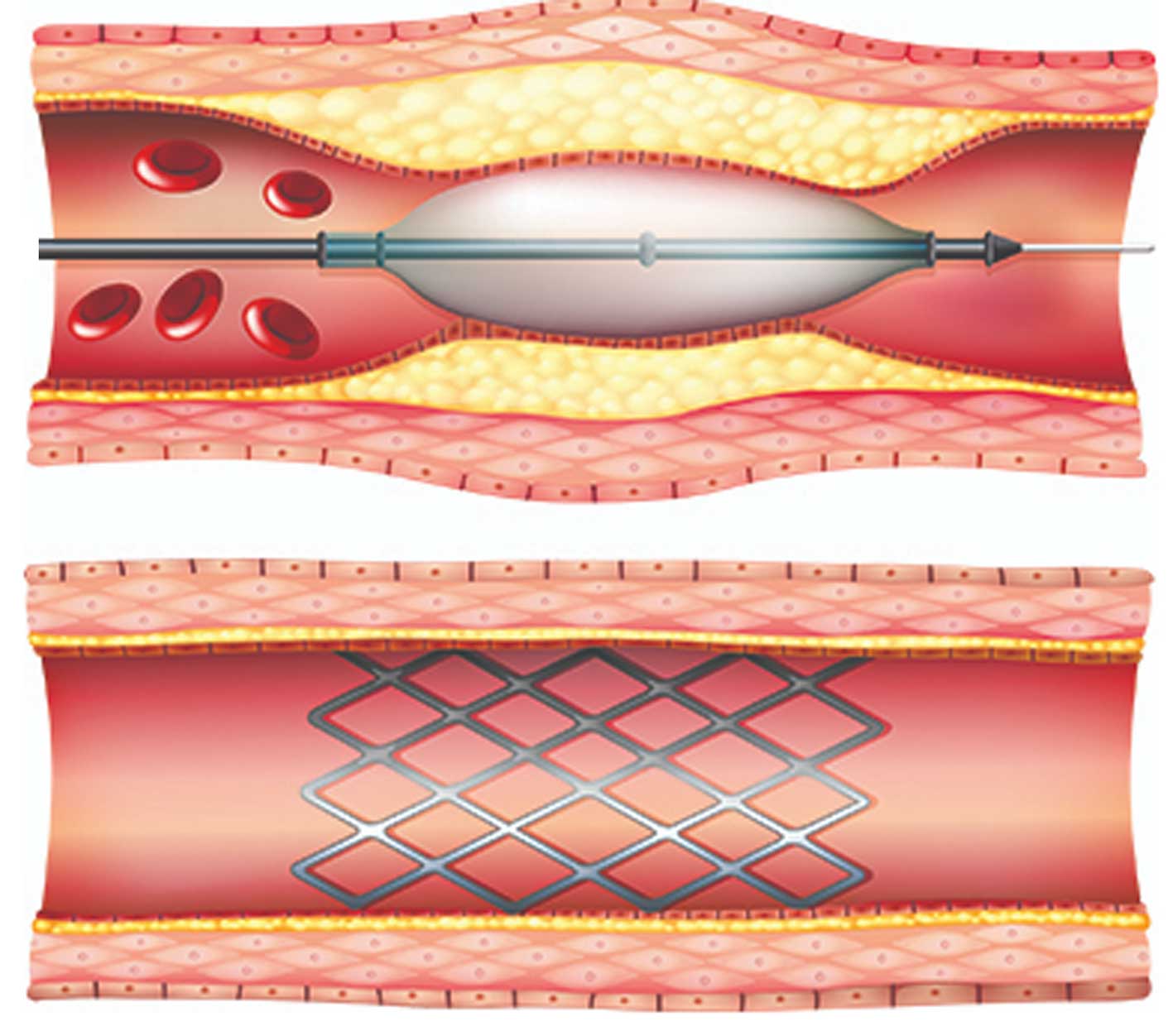 Cateterismo Cardiaco Diagnostico.