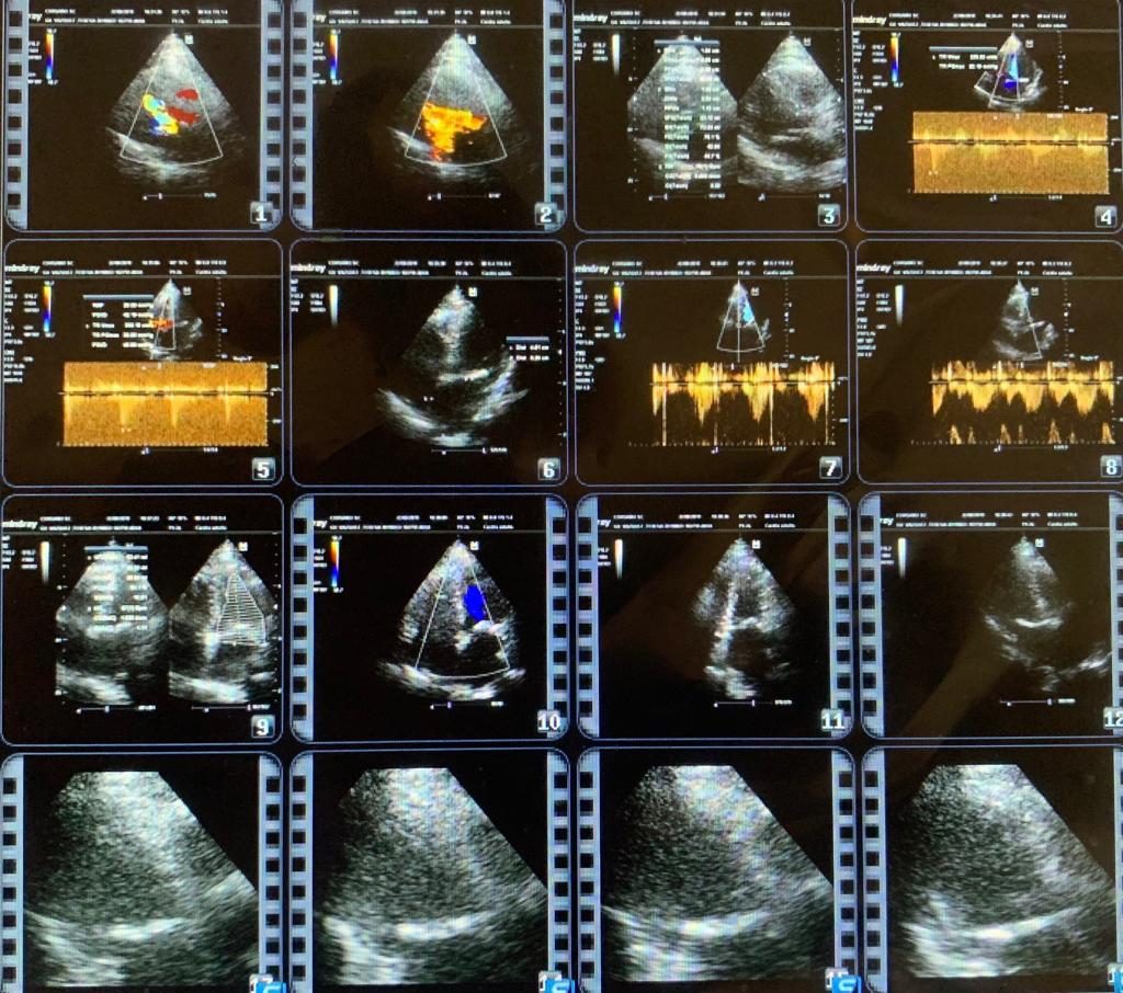 Prueba de esfuerzo Dr. Luis Francisco Santillán Valencia